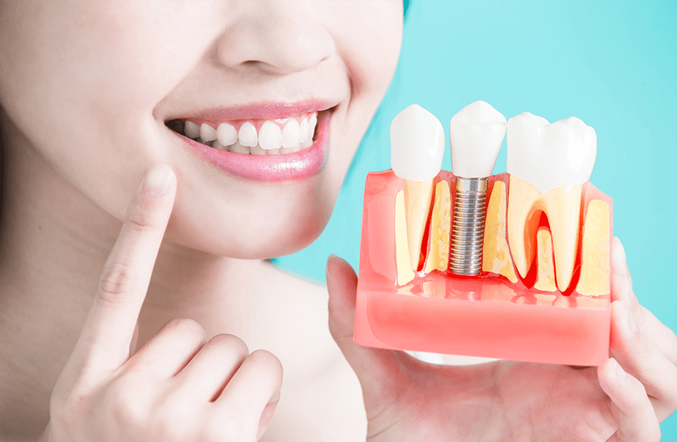 Dental Implant Maroubra