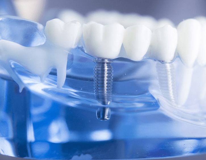 Best Dental Implant Maroubra