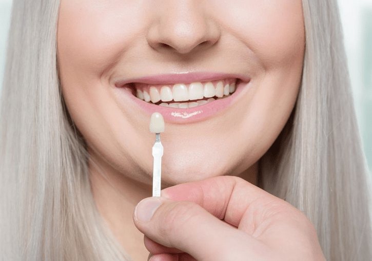 dental veneers in Maroubra