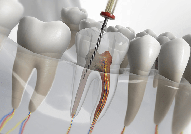 Root Canal Service Dentist Maroubra