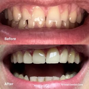 TeethBondingB&A Before and after composite bonding, Total Dental Care Maroubra