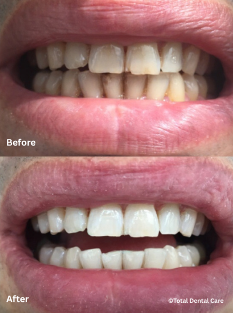 TeethWhiteningB&A Before and after teeth whitening, Total Dental Care Maroubra