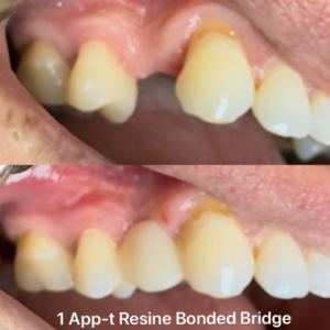 ResineBondedBridgeB&A Before and after resin-bonded bridge, Total Dental Care Maroubra