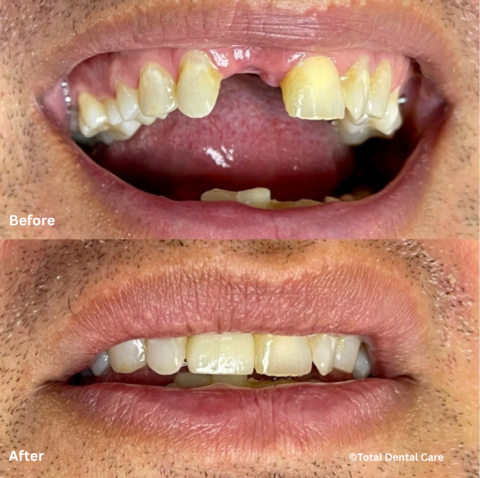 ImplantToothRestorationB&A Before and after implant tooth restoration, Total Dental Care Maroubra