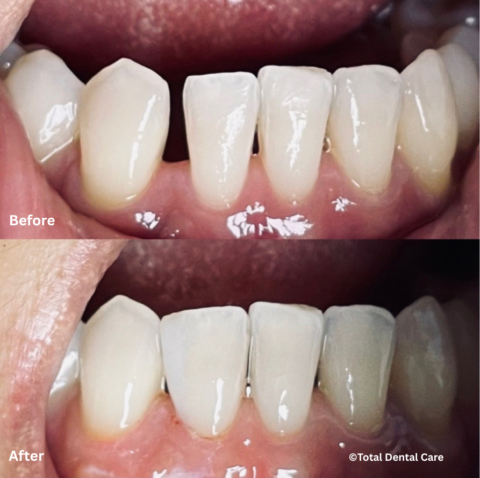 BondingGapClosureB&A Before and after bonding to close gaps, Total Dental Care Maroubra