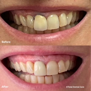 CrownB&A Before and after dental crown, Total Dental Care Maroubra