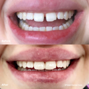 BondingGapClosureB&A2 Before and after bonding to close gaps, Total Dental Care Maroubra