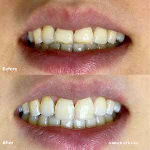 BondingB&A3 Before and after composite bonding, Total Dental Care Maroubra