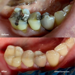FillingB&A Before and after tooth-coloured filling, Total Dental Care Maroubra