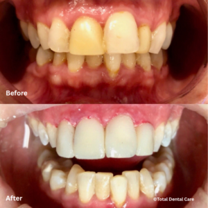 Crown&WhiteningB&A Before and after crown and teeth whitening, Total Dental Care Maroubra