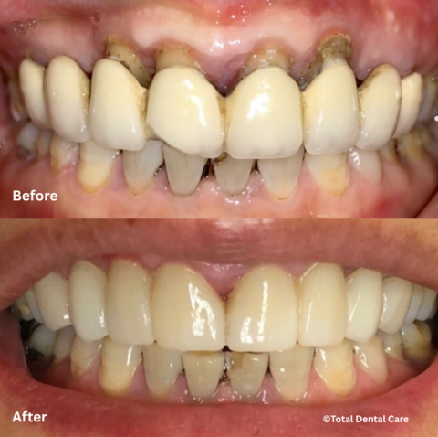 Crown&BridgeB&A Before and after crown and bridge, Total Dental Care Maroubra