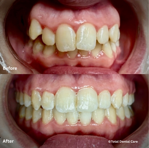 ClearAlignersB&A Before and after clear aligner treatment, Total Dental Care Maroubra
