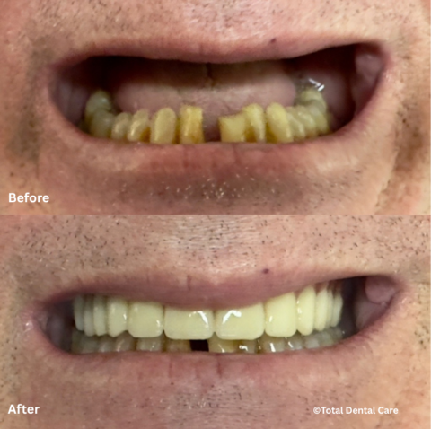 DenturesB&A Before and after dentures, Total Dental Care Maroubra